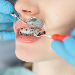 ارتودنسی ثابت؛ روشی پیشرفته برای رفع مشکلات فک و دندان