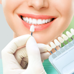 ونیر دندان و راهنمای کامل برای انتخاب آن