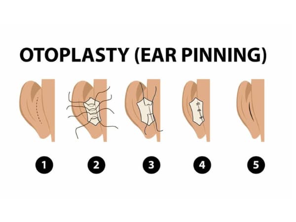 جراحی زیبایی گوش (اتوپلاستی)
