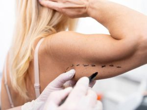 لیپوساکشن بازو چیست و چگونه انجام می شود؟
